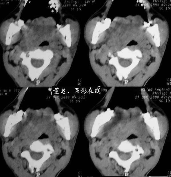 下颌骨旁皮样囊肿 - 颌面,颈部 医影在线