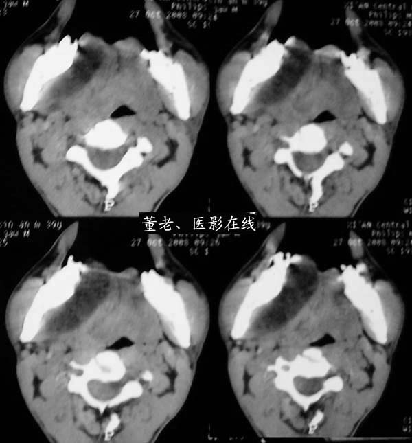 下颌骨旁皮样囊肿