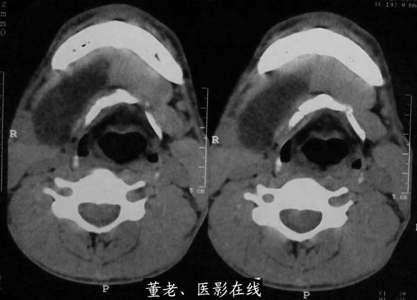 下颌骨旁皮样囊肿