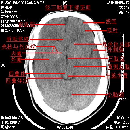 求侧脑室三角的具体位置