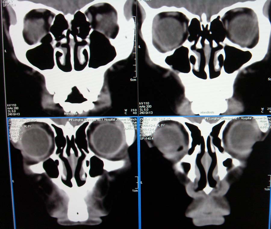 ped1669:m11y,副鼻窦炎 鼻咽部