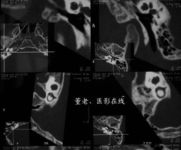 69 门户 69 影像图库 69 ct病例 69 眼,耳,鼻,副鼻窦 69