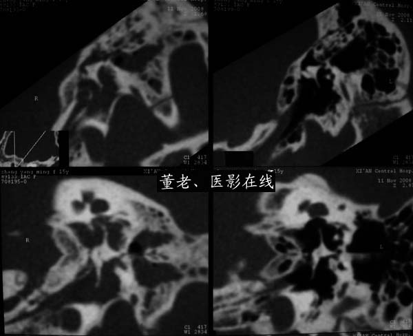 69 门户 69 影像图库 69 ct病例 69 眼,耳,鼻,副鼻窦 69