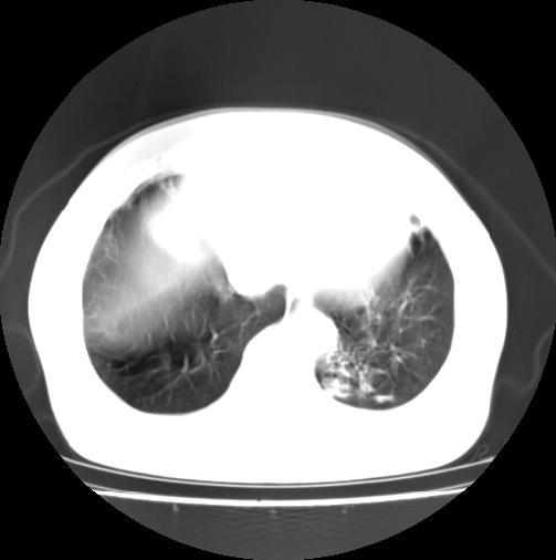 ct16957:f56y,这是先天性肺囊肿,还是支气管扩张?