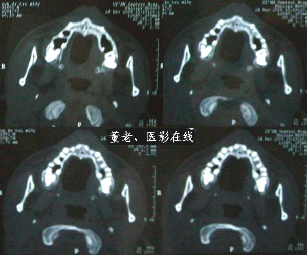 上腭腺样囊性癌