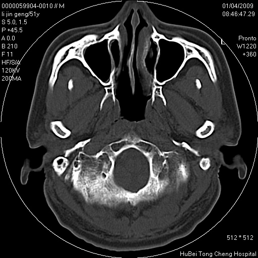 鼻咽部后壁正中部位,起源于脊索退化时粘膜外翻,mri在t2wi上呈脑脊液