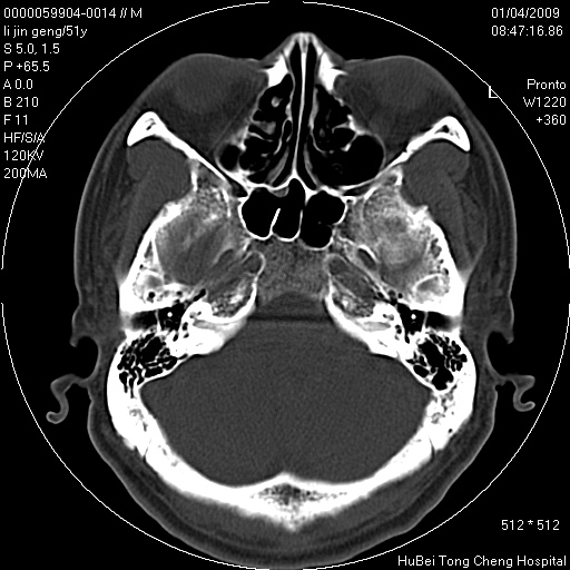 鼻咽部后壁正中部位,起源于脊索退化时粘膜外翻,mri在t2wi上呈脑脊液