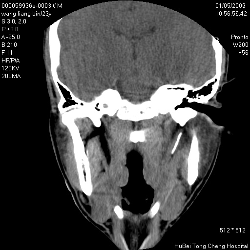ct17597:右侧下颌骨髁状突骨折.