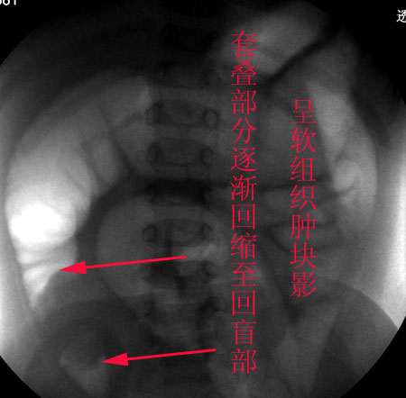 zt0254:小儿肠套叠空气灌肠整复!