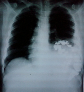 cl0940:膈疝,胸片误诊为胸腔积液.31岁男性,表现胸痛