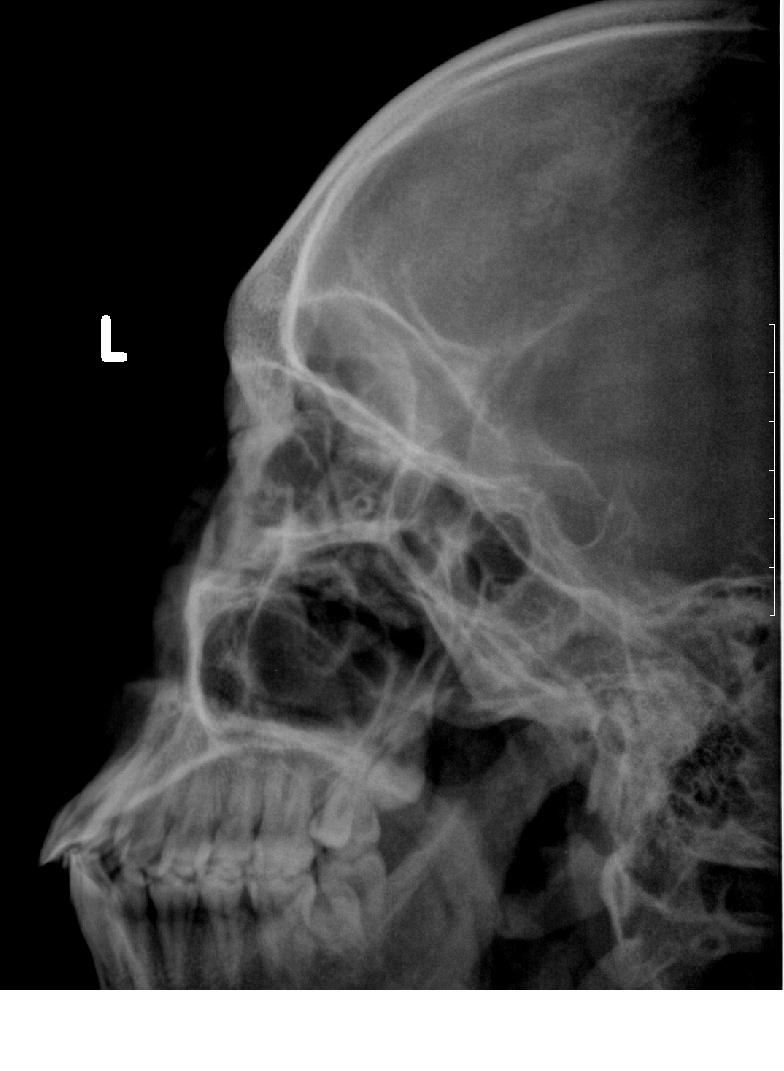 x5312:鼻子外伤后 摄片 是否鼻骨骨折 x线病例讨论 医影在线