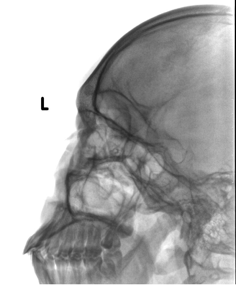 x5312:鼻子外伤后 摄片 是否鼻骨骨折 - x线病例讨论