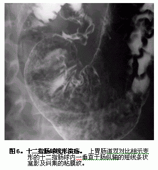 十二指肠溃疡的影像学诊断