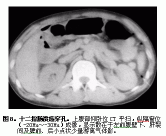 十二指肠溃疡的影像学诊断