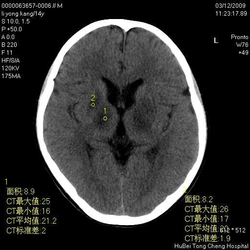 肝豆状核变性