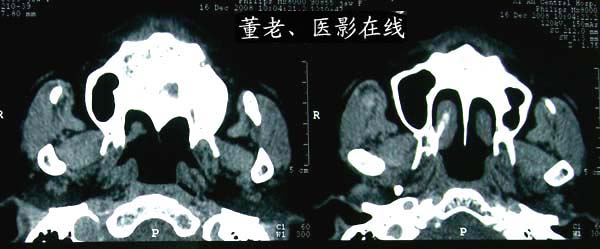 上腭部小涎腺恶性肌上皮瘤(上皮-肌上皮癌)