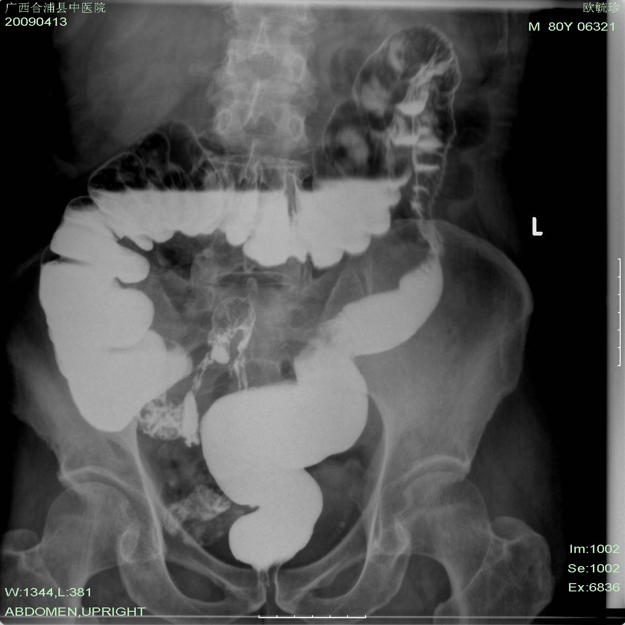 乙状结肠右侧缘见一充盈缺损,降结肠见向心性狭窄.还有一张图片.