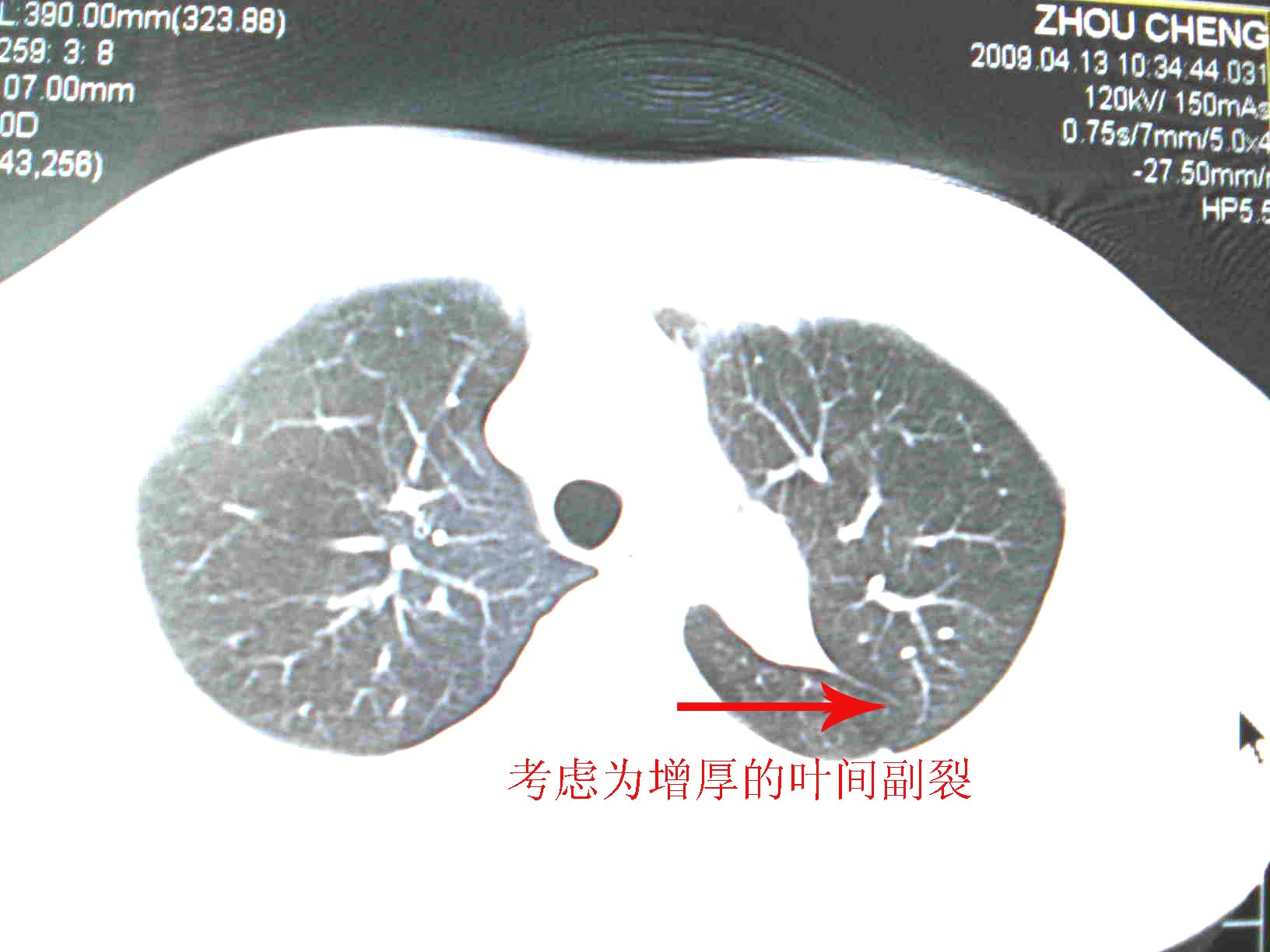 ct19715左主动脉弓旁阴影