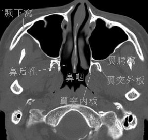 请教翼腭窝,颞下窝的解剖,最好能在ct图像上标注.先谢