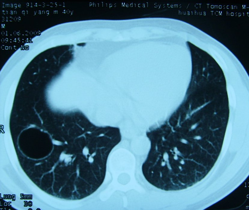 ct20426先天性支气管孤立含气囊肿
