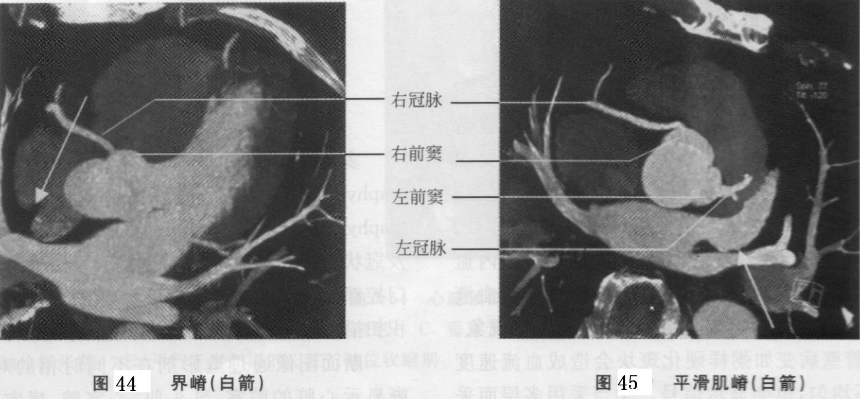 心血管ct解剖