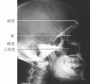 鼻腔,鼻旁窦x解剖