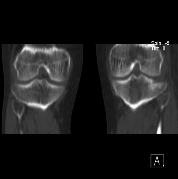 ct21917:右腓骨小头是否骨软骨瘤?