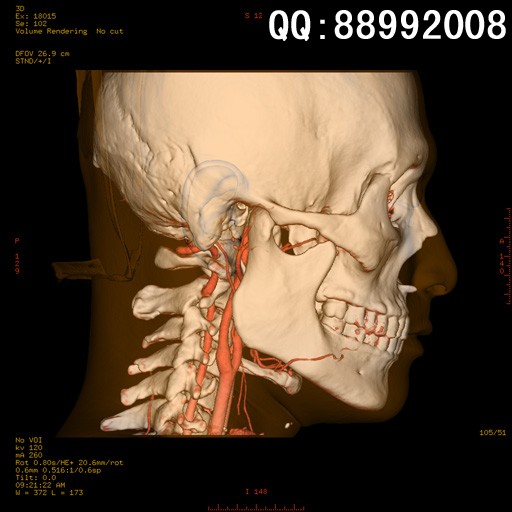 new0423:头颈部血管ct三维重建