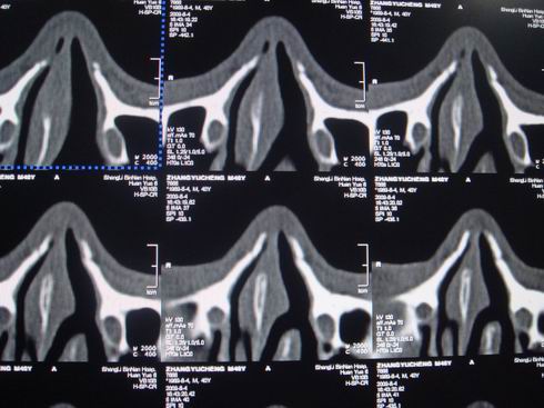 ct21424鼻骨骨折