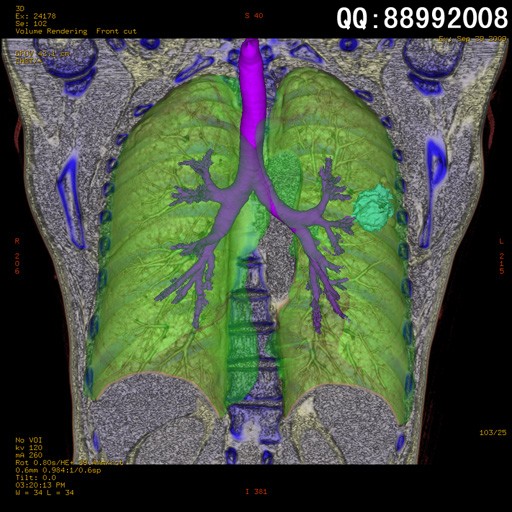 new0466:肺部ct三维重建