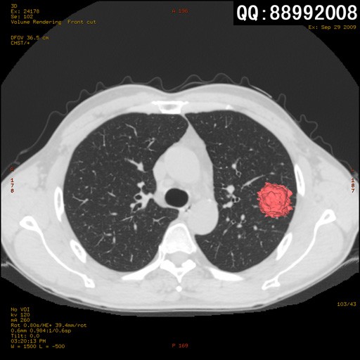 new0466:肺部ct三维重建 影像新技术 医影在线
