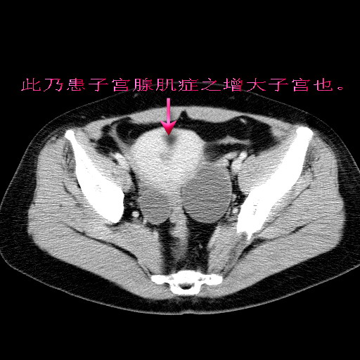 ct23071:子宫肌腺症,/双侧卵巢乳头状浆液性囊腺瘤