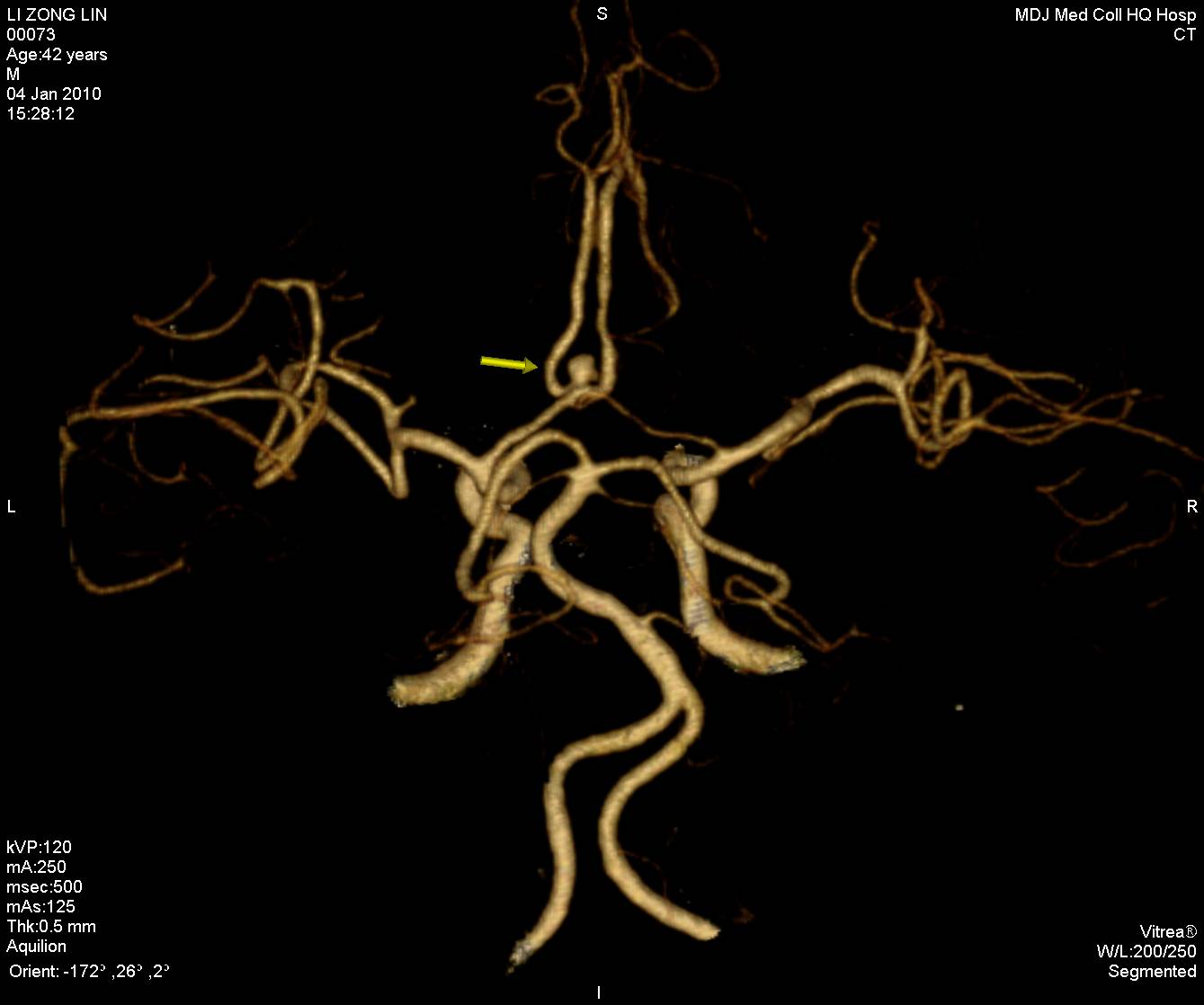new0471cta前交通动脉瘤