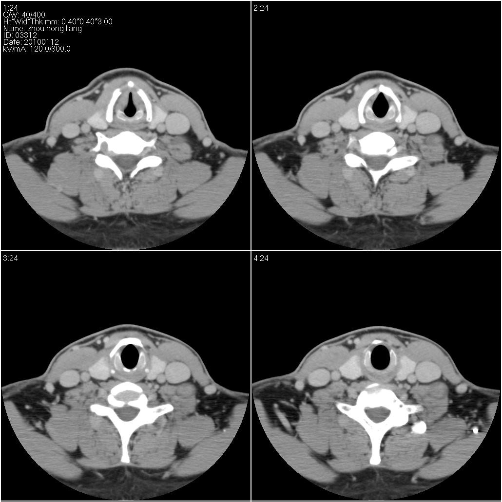 ct24143:颈部肿块,考虑什么性质?