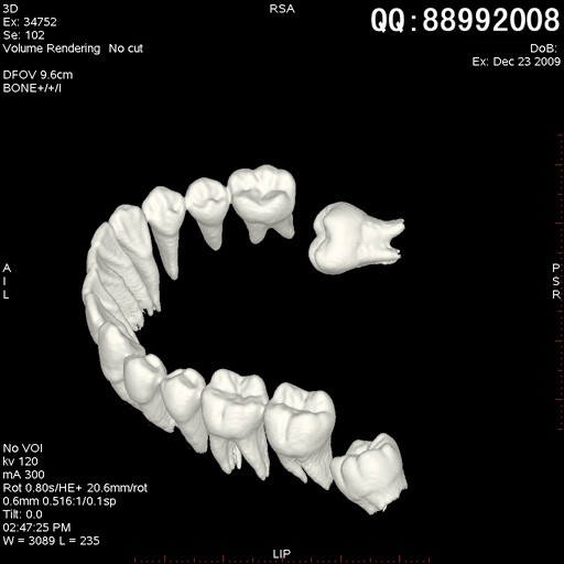 new0475:牙齿ct三维重建