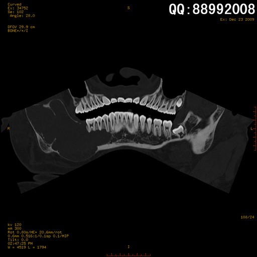 new0475:牙齿ct三维重建