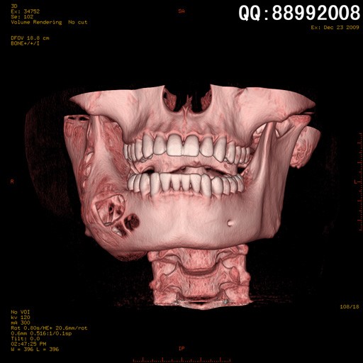 new0475:牙齿ct三维重建
