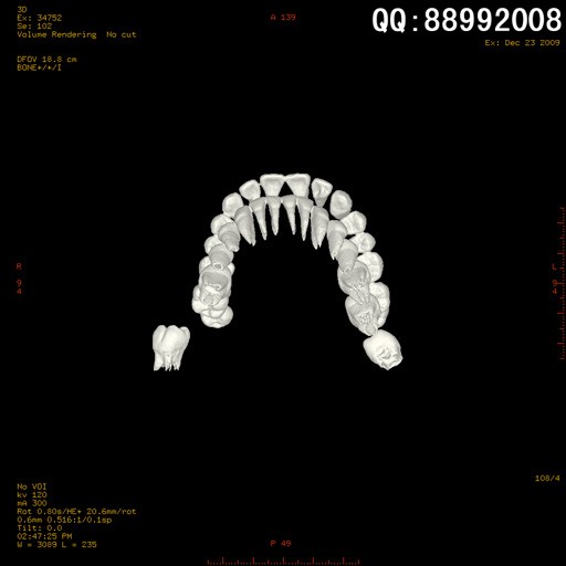 new0475:牙齿ct三维重建