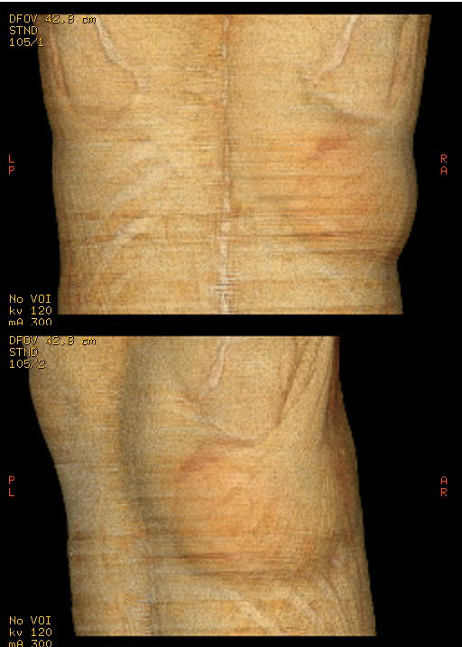 cl2031:背部纤维脂肪瘤