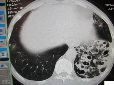 ct24546:支气管扩张?多发性肺囊肿?请高手发表意见吧