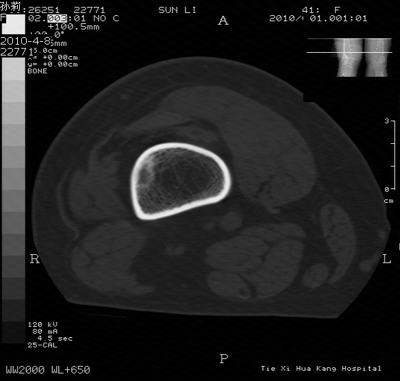 ct25599骨肿瘤请大家谈论