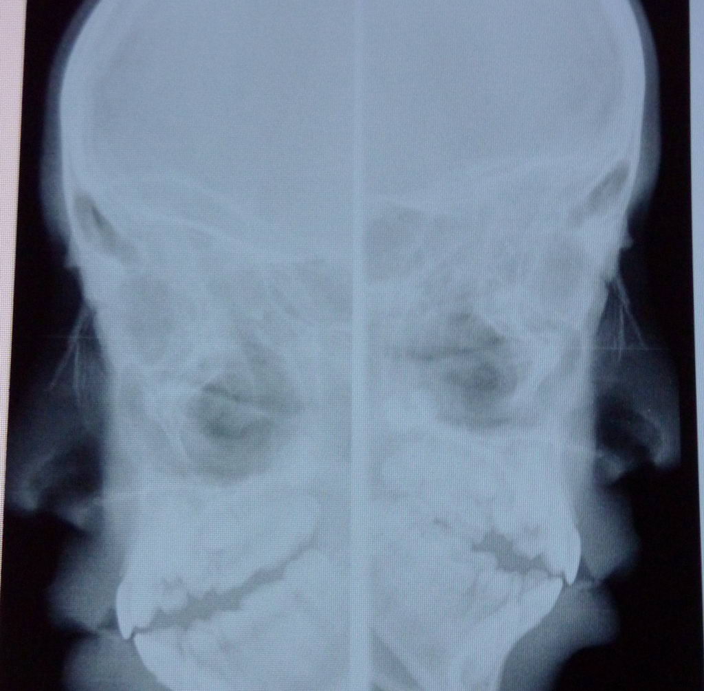 影像读片 69 x线病例讨论 69 x7385:大家看看,这个鼻骨有骨折吗?