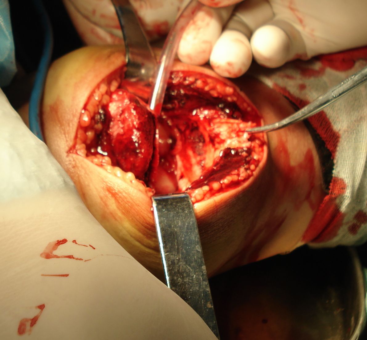 cl2420:右侧髌韧带断裂,关节腔积血