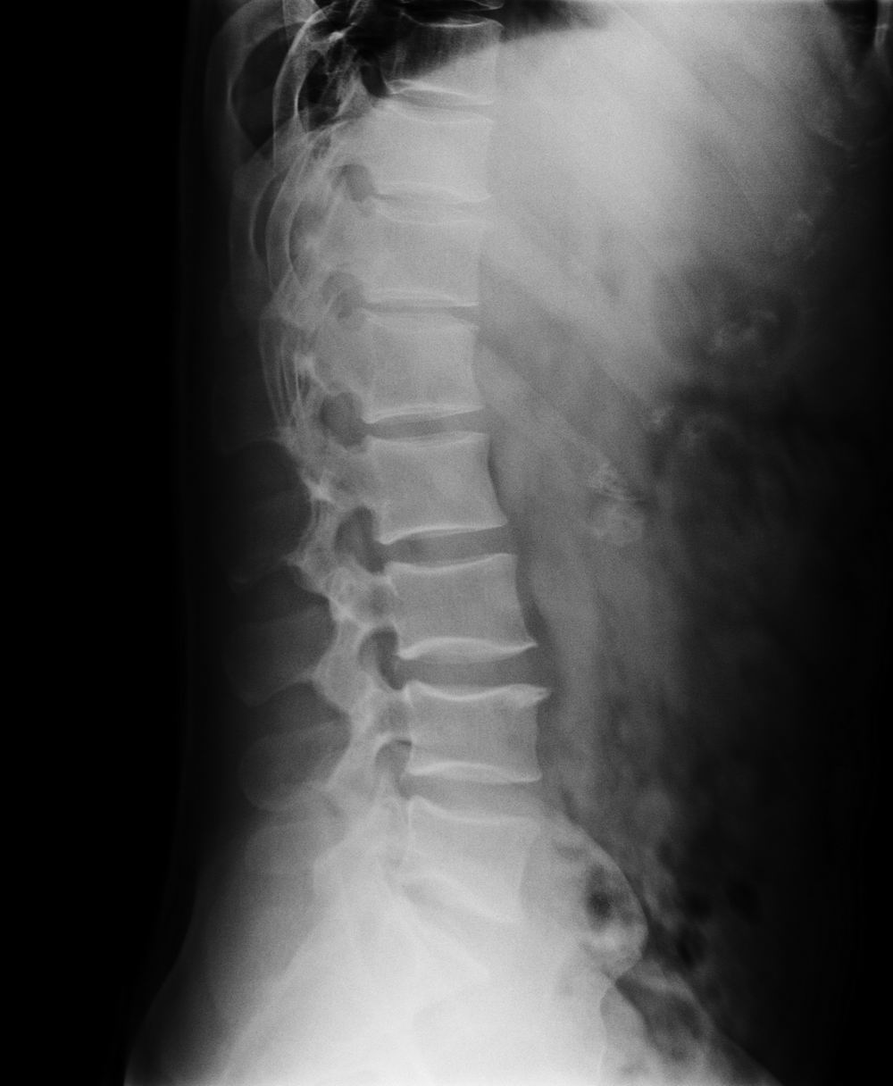 x7637:腰椎多发性横突骨折