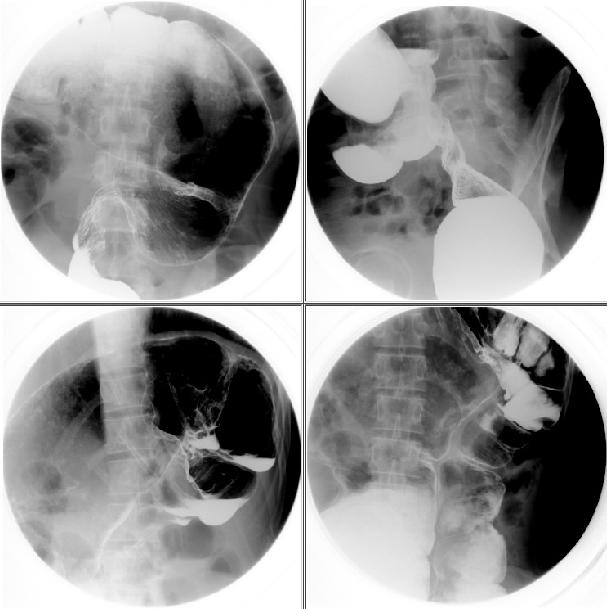 zt0009:x线腹部常见急腹症典型图像