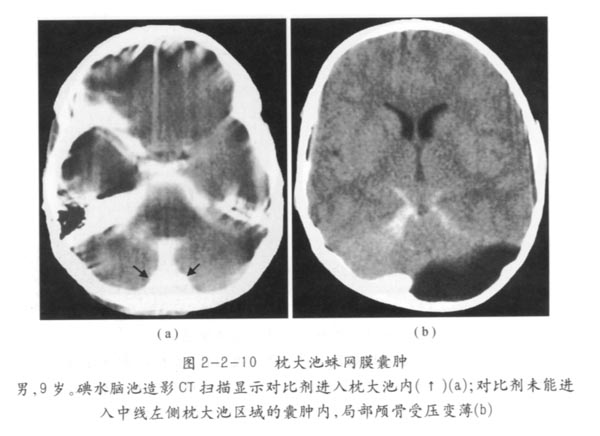 枕大池蛛网膜囊肿04