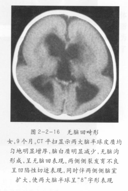 无脑回畸形01