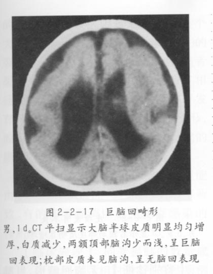 巨脑回畸形01