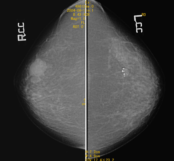 专科检查:右乳腺外上象限实性肿物,直径约2cm,质中.