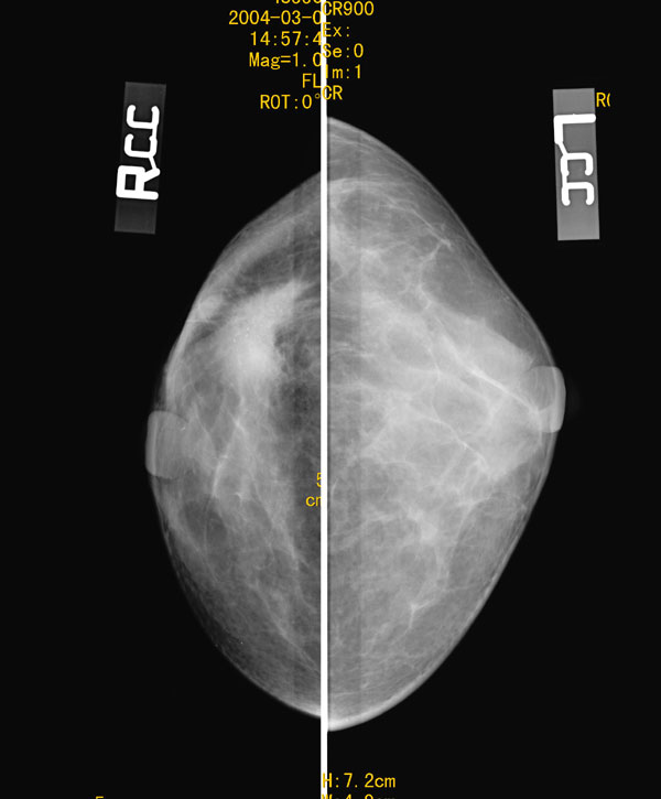 69 查看内容   乳腺钼钯所见:双侧ⅳb型乳腺,右乳腺外上象限见一